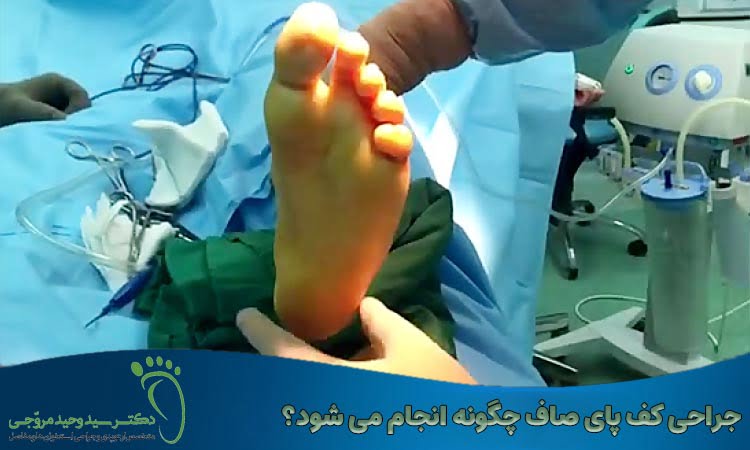 جراحی کف پای صاف چگونه است؟