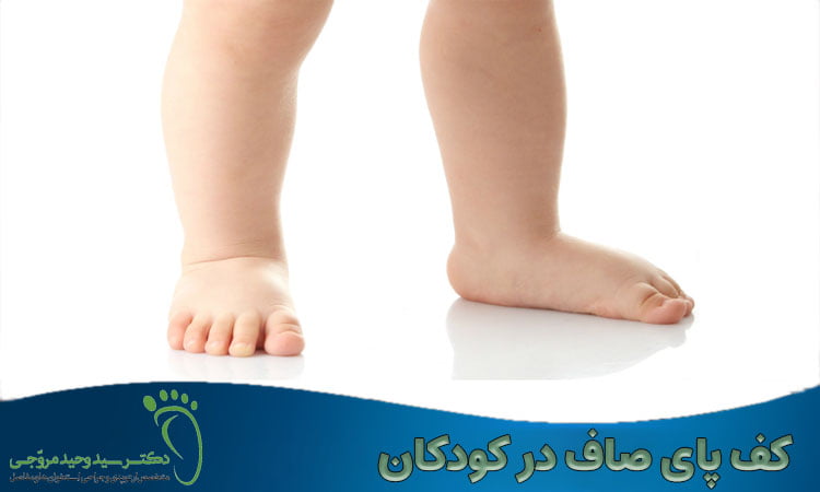 درمان کف پای صاف در کودکان
