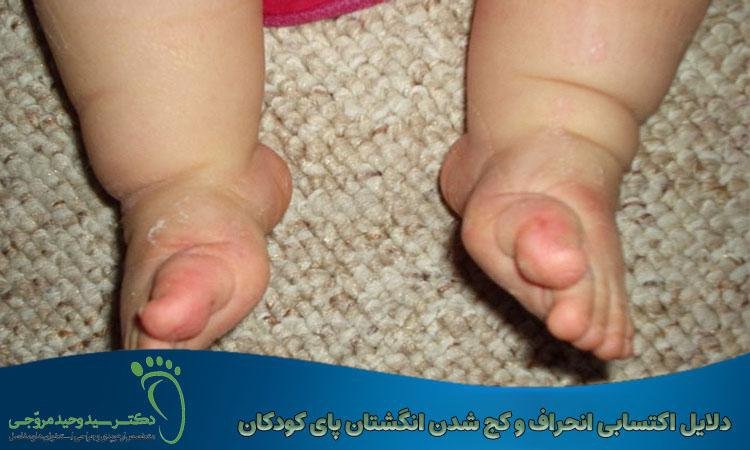 دلایل اکتسابی انحراف و کج شدن انگشتان پای کودکان