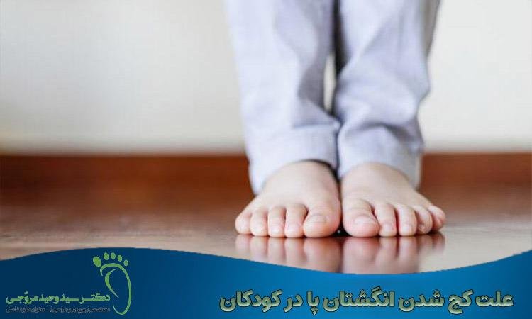 علت کج شدن انگشتان پا در کودکان