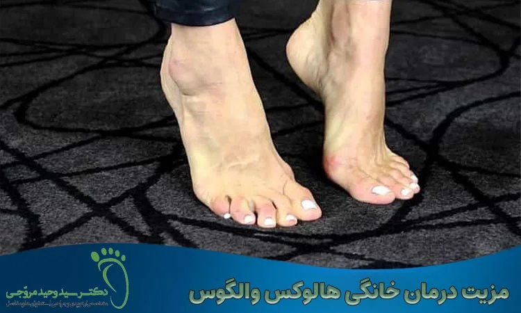 درمان خانگی هالوکس والگوس