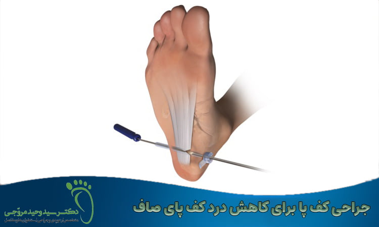 جراحی کف پا برای کاهش درد کف پای صاف