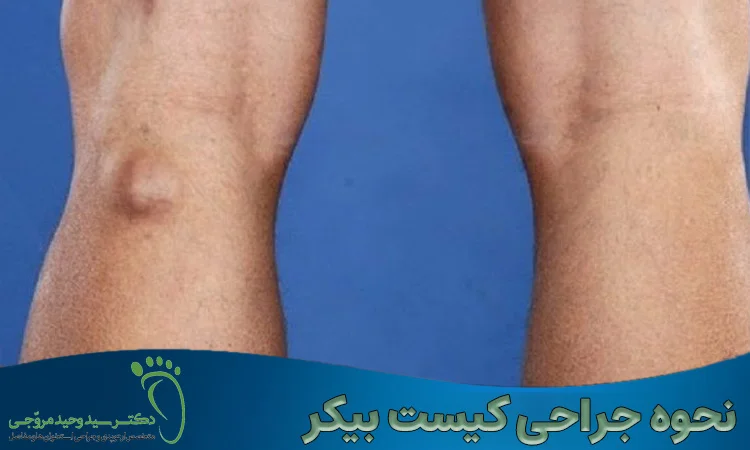 نحوه جراحی کیست بیکر