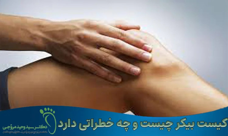 کیست بیکر چیست و چه خطراتی دارد